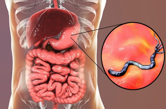 أعراض جرثومة المعدة الظاهرة وعلامات الخطر ..  احذرها