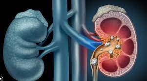 نصائح ناجعة للمصابين بحصى الكلى في رمضان