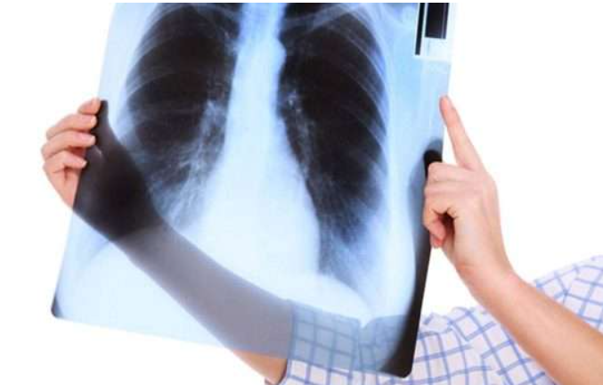 التهاب الشعب الهوائية المزمن Chronic bronchitis