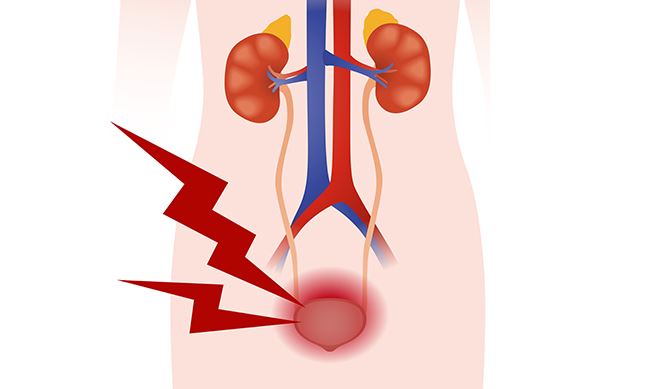 حالة نادرة  ..  انفجار مثانة رجل بسبب عدوى شائعة