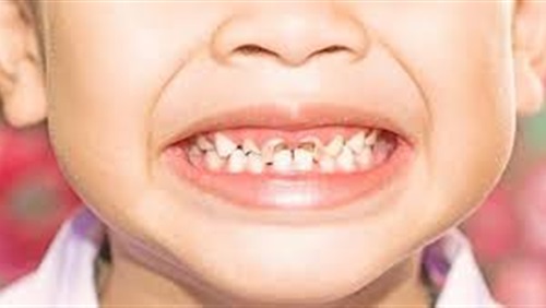 5 نصائح تحمي طفلك من تسوس الأسنان
