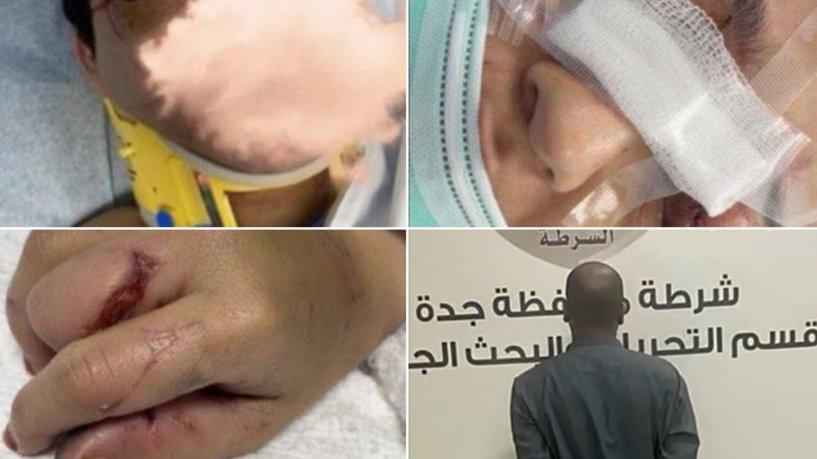 أفقدها بصرها ..  صور صادمة لاعتداء مروع لزوج سعودي على زوجته