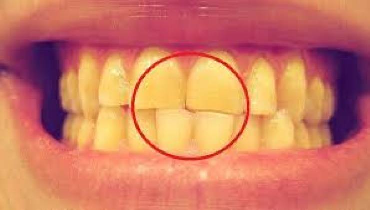 هذه الأطعمة والمشروبات تسبب اصفرار الأسنان