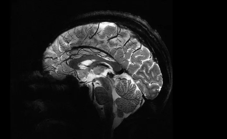 أدق صورة دماغ باستخدام أقوى أجهزة التصوير بالرنين المغناطيسي