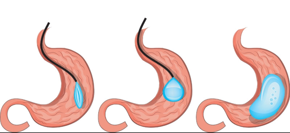 ما تريد معرفته عن بالون المعدة .. !